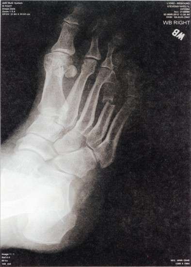 Nyel's Right Foot