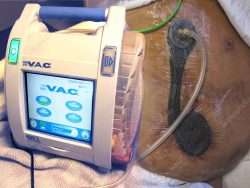 Wound Vac Image From Internet